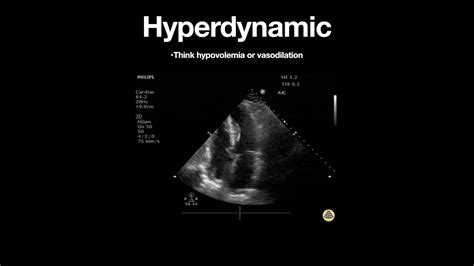 left ventricular function becomes hyperdynamic